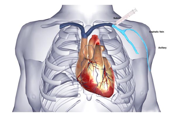 aicd implantation